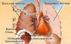 Как понять что астма обострилась. Смотреть фото Как понять что астма обострилась. Смотреть картинку Как понять что астма обострилась. Картинка про Как понять что астма обострилась. Фото Как понять что астма обострилась