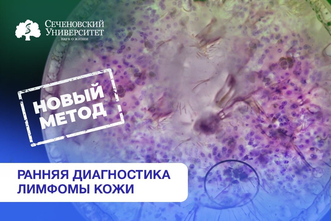  В Сеченовском Университете проводят диагностику лимфом кожи с помощью изучения микроРНК 