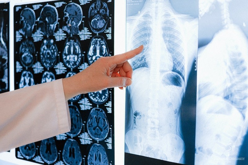 Rare combination of lung diseases in one patient Rare combination of lung diseases in one patient