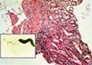 Helicobacter pylori против астмы и аллергии?
