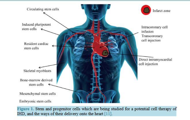 Medics from Sechenov University analyzed cell therapy of ischemic heart disease