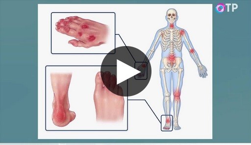 Какие особенности поражения суставов при псориатическом артрите
