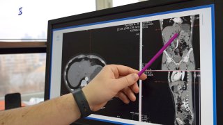 Хирурги Сеченовского Университета удалили пациенту опухоль рядом с сердцем Хирурги Сеченовского Университета удалили пациенту опухоль рядом с сердцем