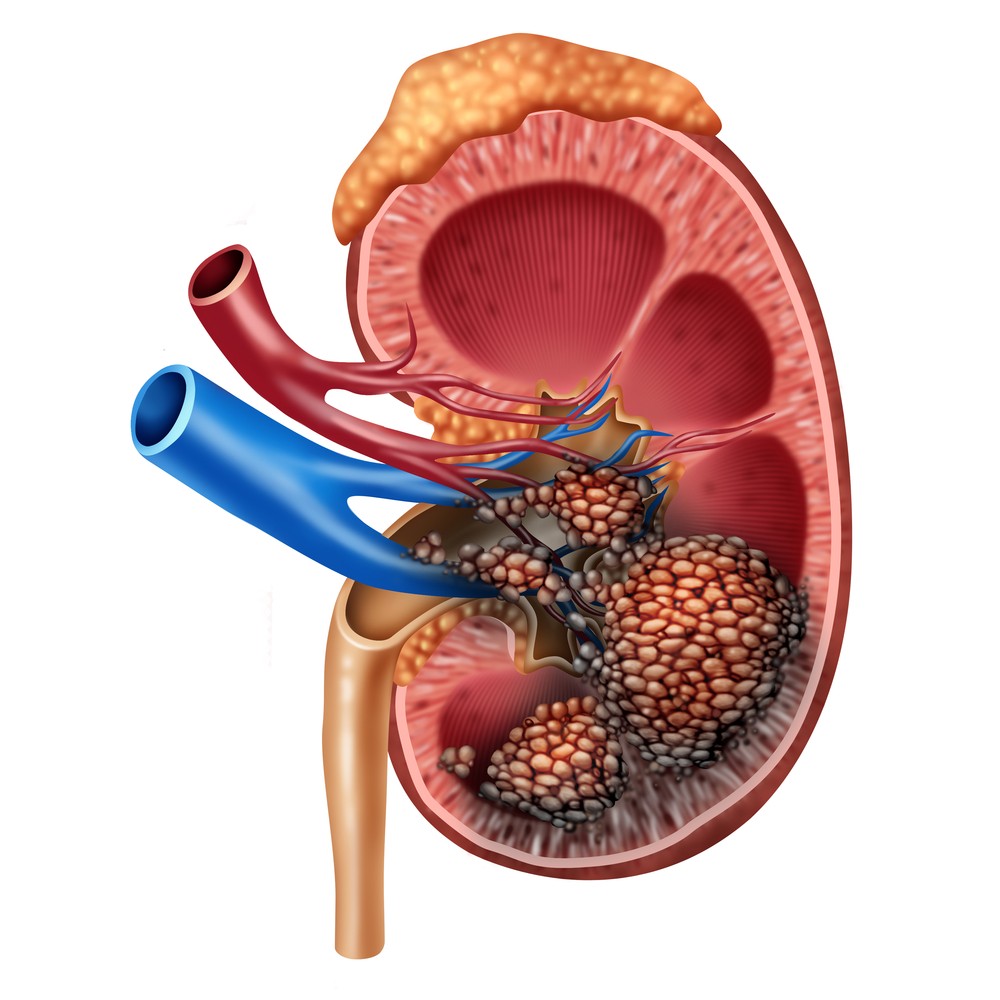 KidneyCancer.jpg