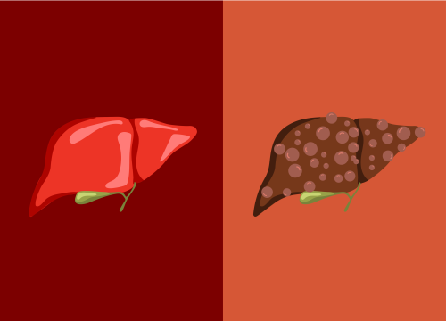 Новый курс: Infections in severe alcoholic hepatitis