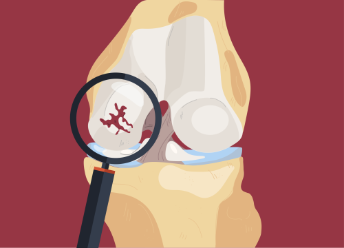 Новый курс: Остеоартроз коленного сустава (гонартроз)