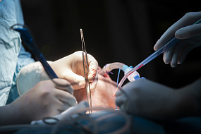 Онкологи Сеченовского Университета первыми в России провели уникальную операцию пациентке с раковой опухолью на лице