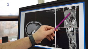 Хирурги Сеченовского Университета удалили пациенту опухоль рядом с сердцем